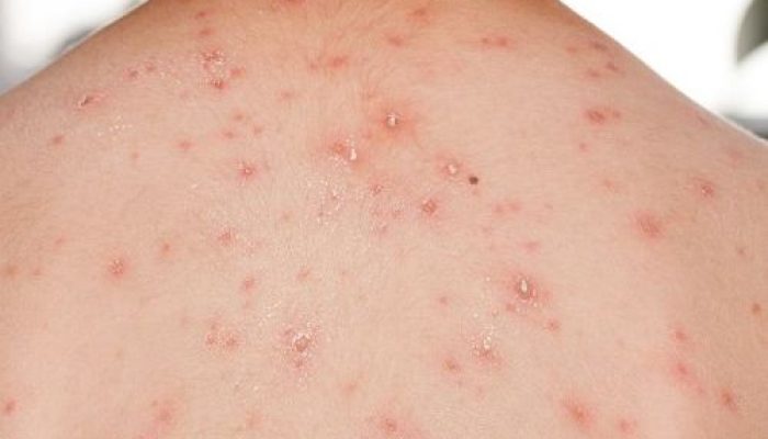 Kemenkes Nyatakan 2 Warga Kepulauan Meranti Negatif Virus Cacar Monyet Setelah Hasil Labor Keluar